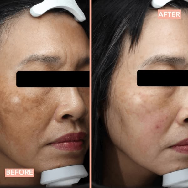 Cyspera Clinically proven results - before and after